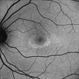 Plaquenil Toxicity